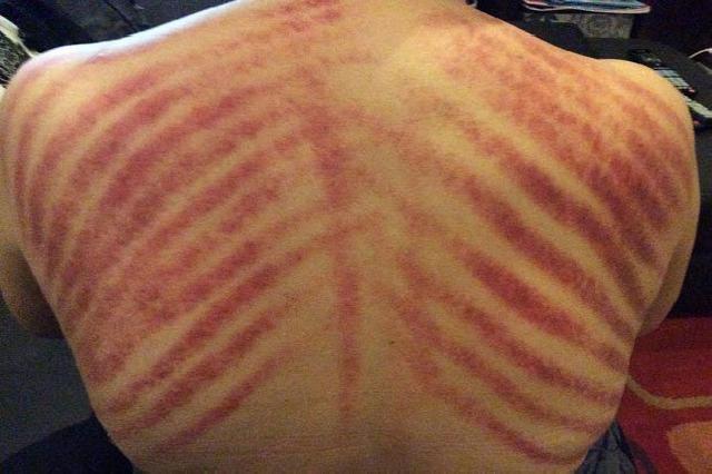 Ini Efek Samping Kerokan yang Bahaya bagi Kesehatan