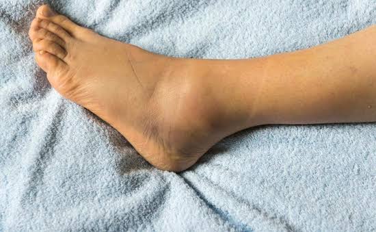 Kaki Bengkak Hingga Nafsu Makan Berkurang Tanda-tanda Kanker Kandung Kemih