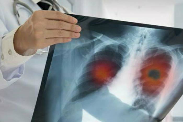 Studi Terbaru Ungkap Pasien Corona yang Sembuh Mengalami Kerusakan Paru-paru