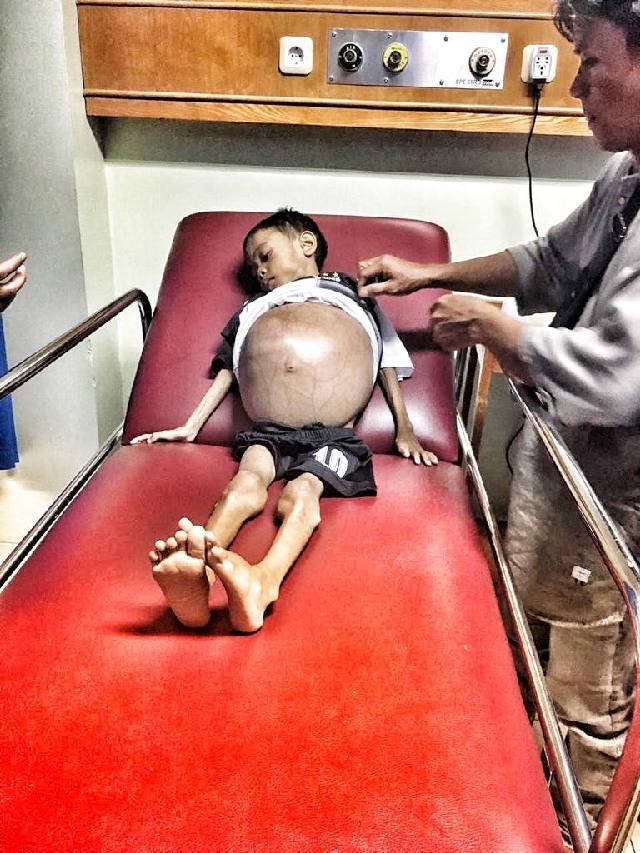 RS PMC Jemput dan Rawat Pitera, Bocah 7 Tahun yang Perutnya Membesar