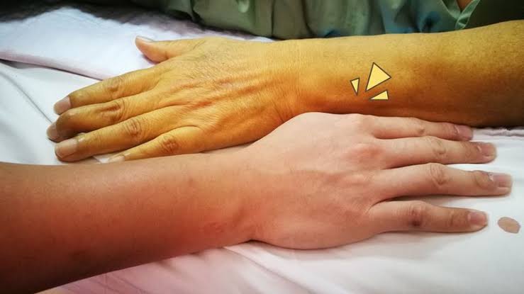 Waspada Mata dan Kulit Menguning Akibat Hepatitis Akut