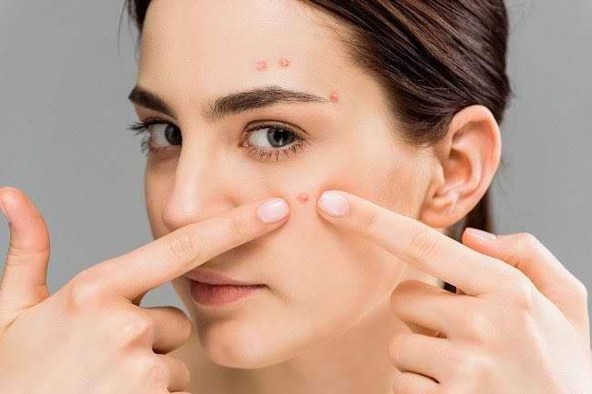 Tak Perlu Pakai Skincare, Ini Cara Cepat Hilangkan Jerawat