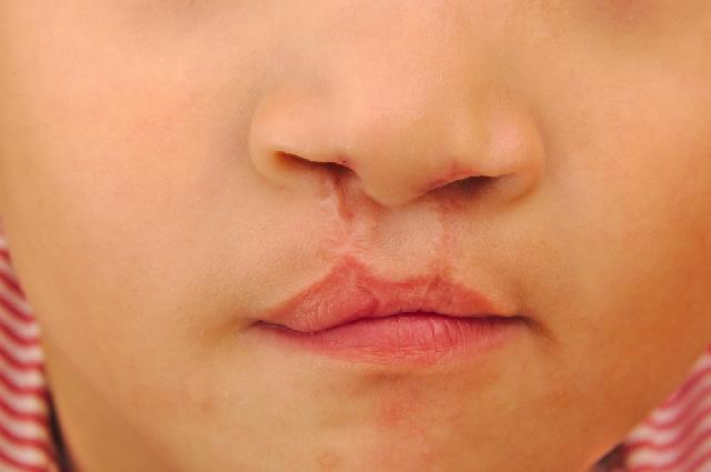 5 Faktor Dominan Pemicu Bibir Sumbing
