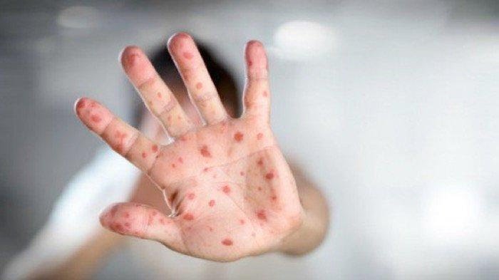 Indonesia Wanti-wanti, Penyakit Cacar Monyet Sudah Terdeteksi di Singapura