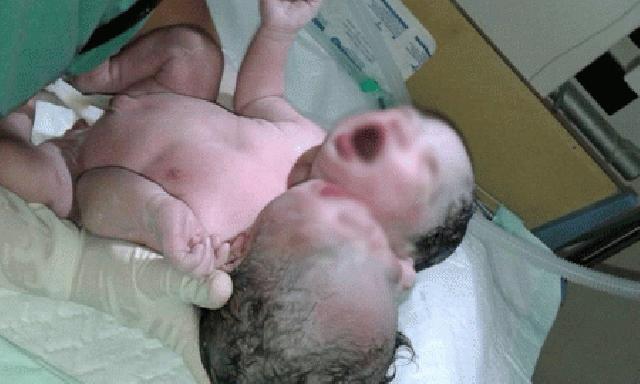 Lahir Berkepala Dua, Ortu Syok dan Pingsan