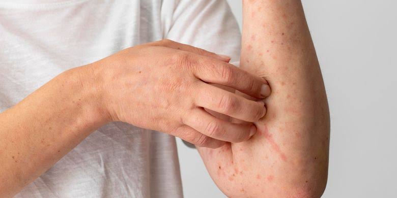 Sumut Diserang Kasus Campak dan Rubela