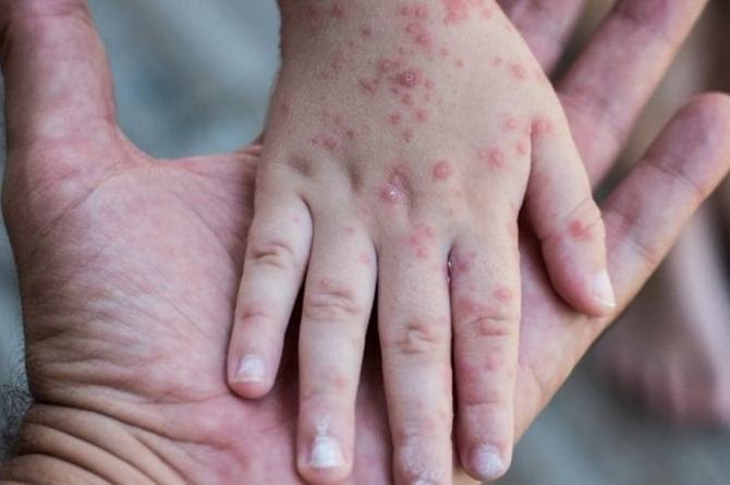 Tak Hanya Hepatitis Akut, Anak Indonesia Waspadai Penyakit Flu Singapura