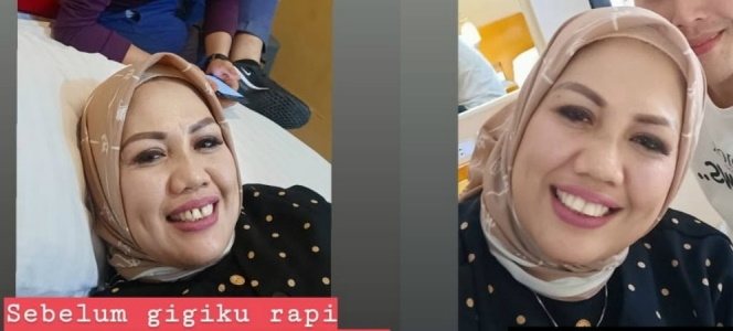 Elly Sugigi Sebelum dan Sesudah Potong Gigi, Bagus yang Mana?