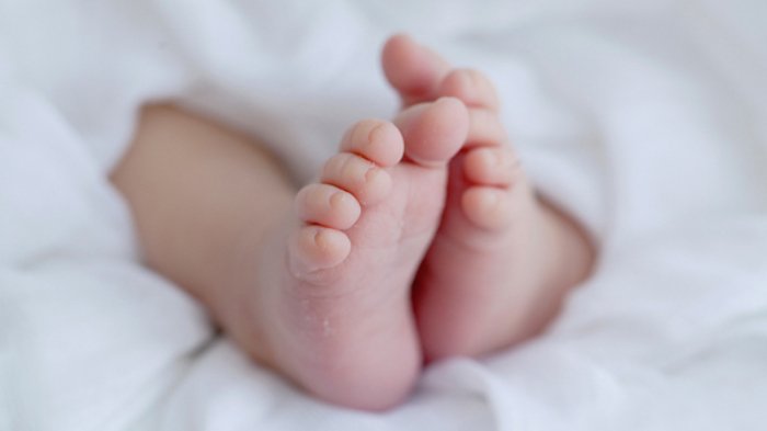 Bayi Bermata Satu dan Tanpa Hidung Lahir di Siak
